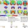Brain-based index may reveal Alzheimer's risk patterns in adults as young as 30