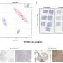 Targeting enzyme could block cancer spread to brain with fewer side effects