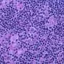 Immunotherapy shows long-term promise in aggressive lymphoma