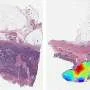 A new AI model enables more efficient analysis of colorectal cancer samples