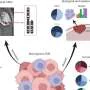 Brain tumor map finds immune cell states that may predict meningioma recurrence