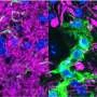 Faulty protein cleanup gene tied to severe early-onset neurological disorders