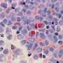 Novel antibody-drug conjugate eliminates residual cancer cells in majority of patients with B-cell ALL