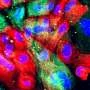 Two prostate cancer mutations reveal opposite responses to ferroptosis therapy