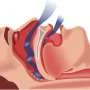 Not just snoring: Obstructive sleep apnea linked to poorer muscle quality and higher fracture risk