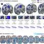 Large-scale brain analysis reveals multiple pathways to placebo effects on pain