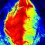 Hibernation-like cooling after stroke may reduce brain damage