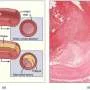 Blood vessels activate self-defense response that may slow atherosclerosis progression